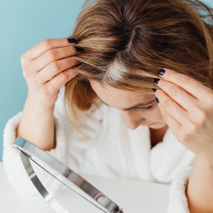 Alopecia en una mujer joven