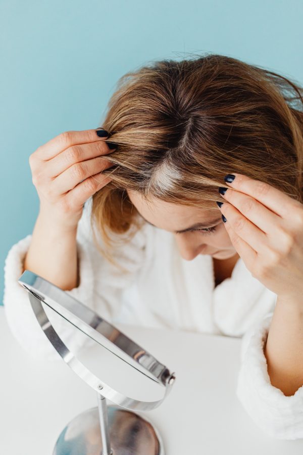 Alopecia en una mujer joven